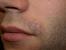 Folliculitis Barbae Treatment