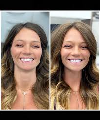 Late post! But it just couldn't wait! Let's give a round of applause for my  dentist @drkennysmiles 👏🏽👏🏽👏🏽 Although, my buck teeth have become a  personality trait… I'm not sad to see