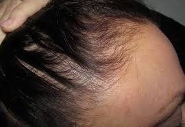 Some types cause temporary hair loss and your hair will grow back. Hair Loss In Women Why It Happens And What You Can Do About It