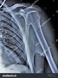 Image result for Shoulder XRay