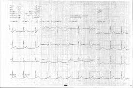 Acute pericarditis is an inflammation of the pericardium characterized by chest pain, pericardial friction rub, and serial ecg changes. Acute Pericarditis Cardiology