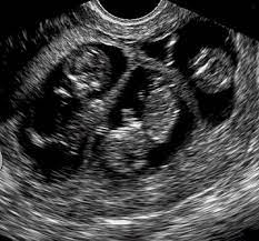 lyonsdenmom com archive april triplet babies baby ultrasound triplets