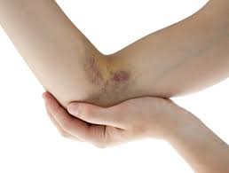 'bluterguss' auch in diesen einträgen. Was Tun Bei Bluterguss Ihre Apotheke Gibt Rat