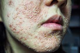 Lakukan cara ini selama sehari sekali dan dalam waktu kurang dari 10 hari maka tahi lalat akan terlepas. Apa Sih Merkuri Dan Bagaimana Cara Mendeteksi Pada Skincare Yang Kita Gunakan