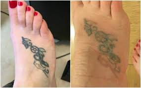 Mainly to identify themselves with a social or religious group, to gift their bodies with protective symbols, or just because of pure art. Experience With Picosure Laser Tattoo Removal Nyc Laser Tattoo Removal Laser Tattoo Tattoo Removal