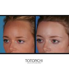 Before & After Forehead Reduction This patient received a 2.5 cm reduction.  The beveled incision allows hair to grow through the scar, fully concealing  it over time. If you have questions about