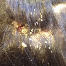 Seboreik Dermatit Seboreik Dermatit Sac Doker Mi