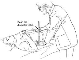 Measurement Of The Sagittal Abdominal Diameter Sad In A