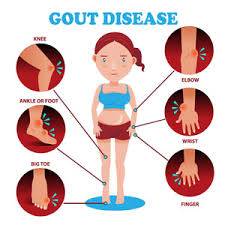 Refractory Gout Signs Symptoms Treatment Diagnosis National Kidney Foundation