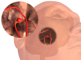 Conocer los signos, tratamientos y posibles secuelas. Medlineplus Espanol Twitterissa Un Aneurisma Cerebral Es Un Ensanchamiento Anormal En La Pared De Un Vaso Sanguineo Del Cerebro Como Se Reparan Los Aneurismas Cerebrales Enterate Aqui Https T Co Lbb0vvb9in Https T Co Qefpkp6ya1