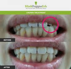 Harga asli bergantung dengan kondisi gigi pasien dan dapat ditentukan setelah diperiksan dan dikonsultasikan dengan dokter gigi tami dental care. Klinik Pergigian Erfa Dentist In Kuala Lumpur