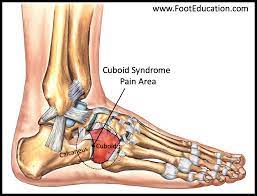 Cuboid Syndrome Footeducation