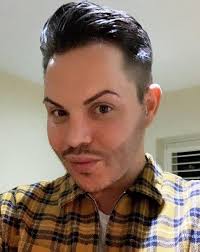 TOWIE's Bobby Norris reveals bizarre beard transplant