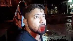 Thai Woman Bites Indian Tourist S Lower Lip Off During Fight On Pattaya S Walking Street Video Coconuts Bangkok This addiction requires you to bite the bottom of your lip repeatedly just whenever you feel like, and sometimes you won't even notice. thai woman bites indian tourist s lower