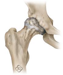 Maybe you would like to learn more about one of these? Total Hip Replacement Surgery Hip Prosthesis Joint Surgeon Com
