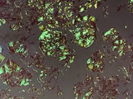 Amyloid lightchain (al) amyloidosis stain with congo red just like the amyloid a (aa) type amyloid and exhibit yellow/orange/green colours under the. Congored Hashtag On Twitter