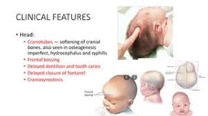 Image result for Craniotabes