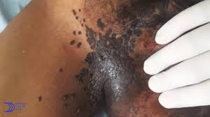 VPH en hombres fotos reales - Urólogo Daniel Carrillo