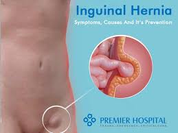 Image result for Inguinal hernia man