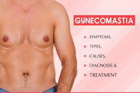 Gynecomastia can also result from tamoxifen or radiation therapy prescribed to men with prostate cancer because the treatment blocks male hormones. Know About Different Types Of Gynecomastia Gynecomastia Symptoms