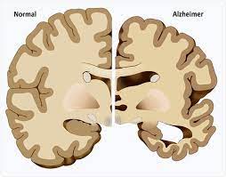 Fahn, director of the center for parkinson's disease and other movement disorders at columbia university as well as past president of the. What Causes Dementia