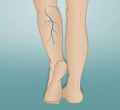 почему немеют конечности рук и ног во время сна Varikoz Uprazhneniya Dlya Borby S Rasshireniem Ven Health Fitness Beauty Health