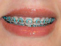 210 Braces Stuff Ideas Braces Braces Colors Teeth Braces