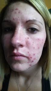 Crohn's & Colitis Foundation