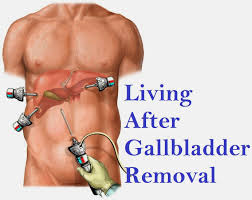 Living After Gallbladder Removal Gallbladder How To Remove Healthy Mind And Body