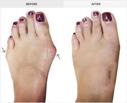 This corrector comfortably bends in the bone and toe, as well. Before And After Bunion Pictures The Bunion Institute Los Angeles