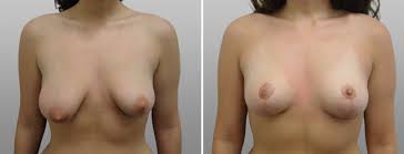 Tuberous Breasts Before and After Images | Form & Face