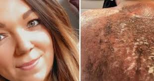 Poparzenia słoneczne: pokazała jak wyglądają jej plecy po opalaniu