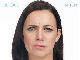 Reconstituted xeomin may be stored in a refrigerator at 2° to 8°c (36° to 46°f) for up to 24 hours until time of use *when using 8 ml of diluent for a 100 unit or 200 unit vial of xeomin, complete the following steps: Botox Dysport Xeomin Jeuveau Dermatology Specialists Of Naples Naples Fl Botox