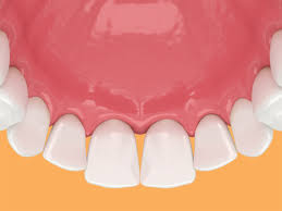 How to fix a small gap in your teeth. 7 Ways To Fix Black Triangles Between Your Teeth