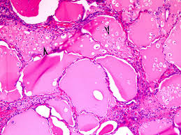 As you will learn in the immune system sequence, graves disease is a type ii immune response that targets thyroid stimulating hormone (tsh) receptors on the thyroid. Frontiers The Pathology Of Hyperthyroidism Endocrinology