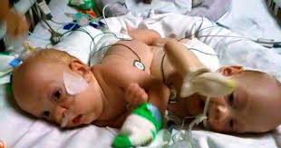 Separan en Florida a siameses de cinco meses unidos por el abdomen