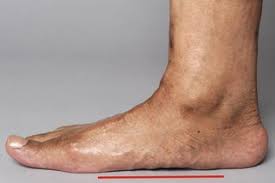 We did not find results for: Flat Feet Nhs