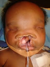 Le syndrome de treacher collins (stc) ou syndrome de franceschetti (sf) est une maladie génique rare. Maladies Rares En Pediatrie