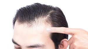 But for the average joes who don't wear it so well, there are some answers to fix the dreaded receding hairline. How To Stop A Receding Hairline Quickly The Trend Spotter