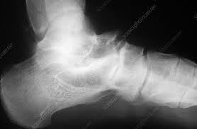 Image result for Osteomyelitis XRay