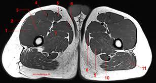 Msk_lower limb by angelo gambino. Mri Of The Thigh Detailed Anatomy Superior Part W Radiology