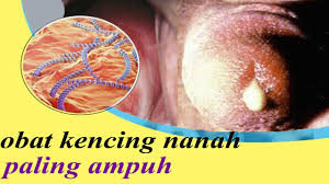 Obat raja singa di apotik kimia farma. Obat Raja Singa Obat Kencing Nanah Di Apotik Obat Sipilis Raja Singa Mujarab Youtube