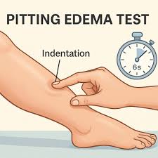 Image result for Edema