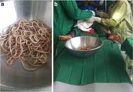 Muka si sakit pucat, badan lesu dan tiada nafsu makan. Dokter Temukan Puluhan Cacing Hidup Di Dalam Perut Bocah 4 Tahun Kumparan Com