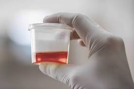 Warna merah air kencing di bawah saturnisme. Hematuria Penyebab Gejala Dan Pengobatan