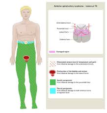 Incomplete Spinal Cord Syndromes Amboss
