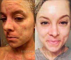 Catriona Gray opens up about her sensitive skin and how she found the best  way to care for it. Read the full story here: https://tinyurl.com/bdckbjra