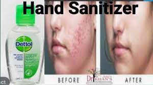 Work For Acne Pimple Bacteria Clean Hand Sanitizer Youtube