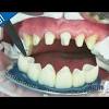 If you get dental implants, you can expect to spend $3,000 to $5,000 per tooth. 1