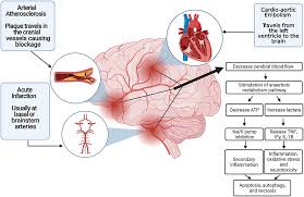 Image result for Stroke Pathophysiology